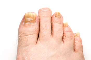 Fungal toenails  treatment in the Cherokee County GA: Canton, Holly Springs, Sixes, Kennesaw, Acworth, Bridgemill, Keithsburg, Avery, Buffington, Sutallee, Lebanon, Kellogg Creek, Hickory Flat areas